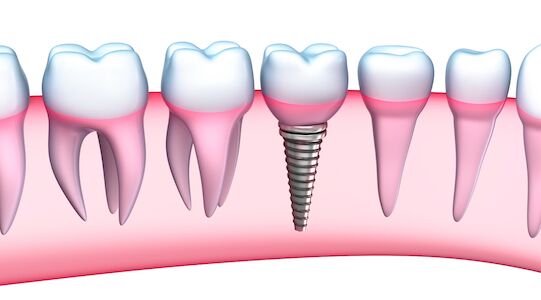 dental implants durham, nc